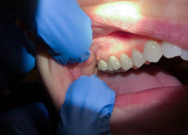 Best Emergency Root Canal Treatment in Clinton, NC